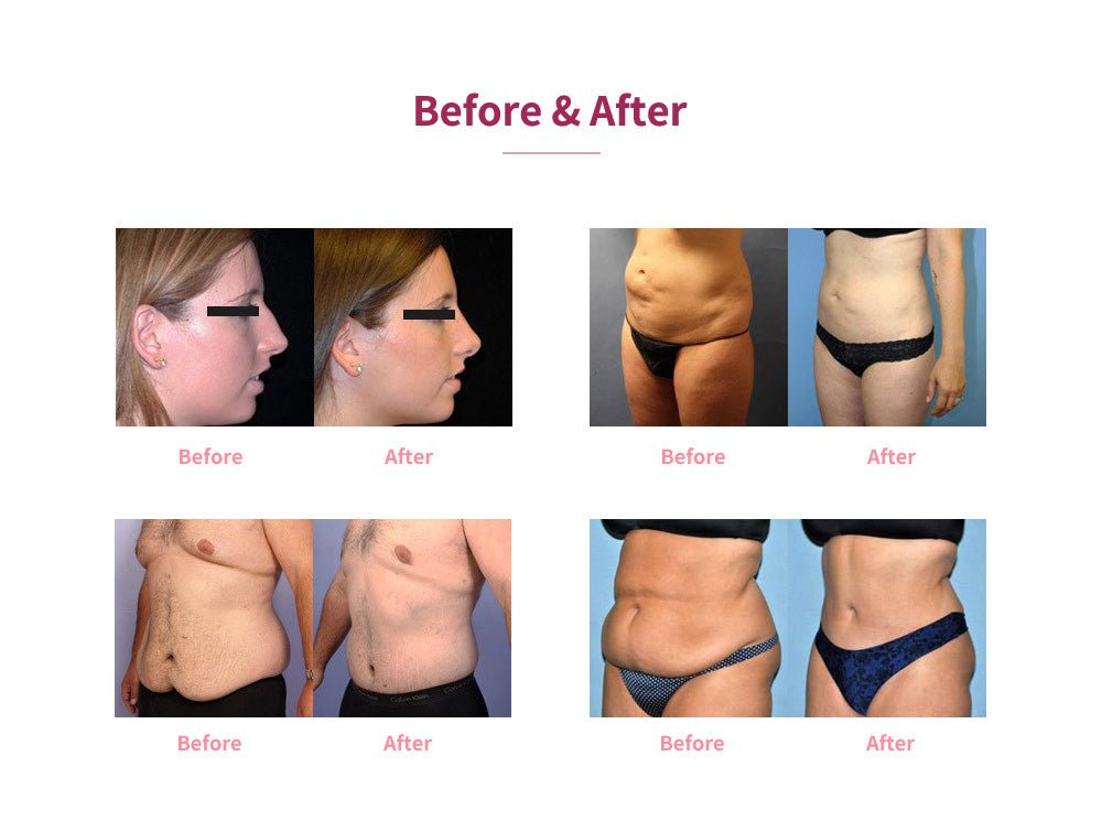 Shape Tactics 5-in-1 Cryolipolysis Vacuum RF Cooling System Shape Tactics 5-in-1 Cryolipolysis Vacuum RF Cooling System