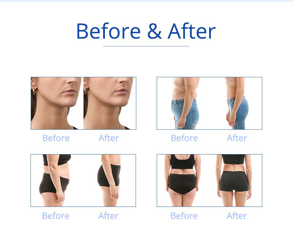 Shape Tactics 5-in-1 RF Cavitation Double-Handle Cryolipolysis Cooling System Shape Tactics 5-in-1 RF Cavitation Double-Handle Cryolipolysis Cooling System