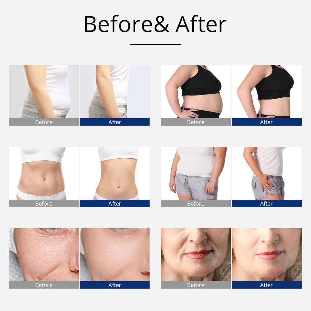 Shape Tactics 5-in-1 Unoisetion Cavitation 2.0 3D Smart Vacuum RF System Shape Tactics 5-in-1 Unoisetion Cavitation 2.0 3D Smart Vacuum RF System