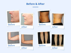 Shape Tactics Cryotherapy 40K Cavitation & RF Contouring System - Machine Horizon