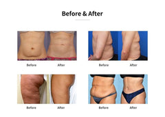 Shape Tactics Dual-Handle Cooling Cavitation & RF Contouring System - Machine Horizon