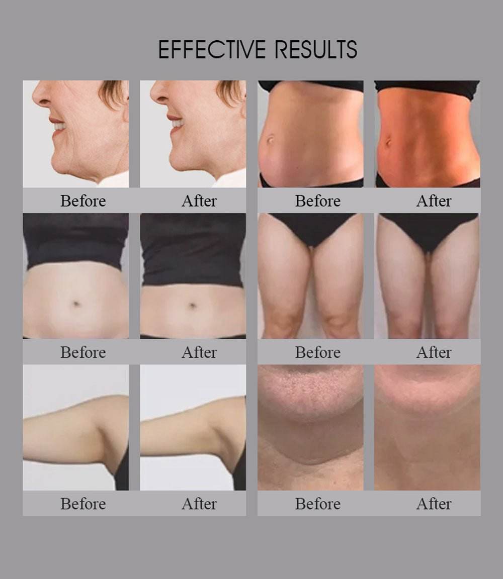 Shape Tactics Smart RF Body Contouring and Skin Rejuvenation System - Machine Horizon