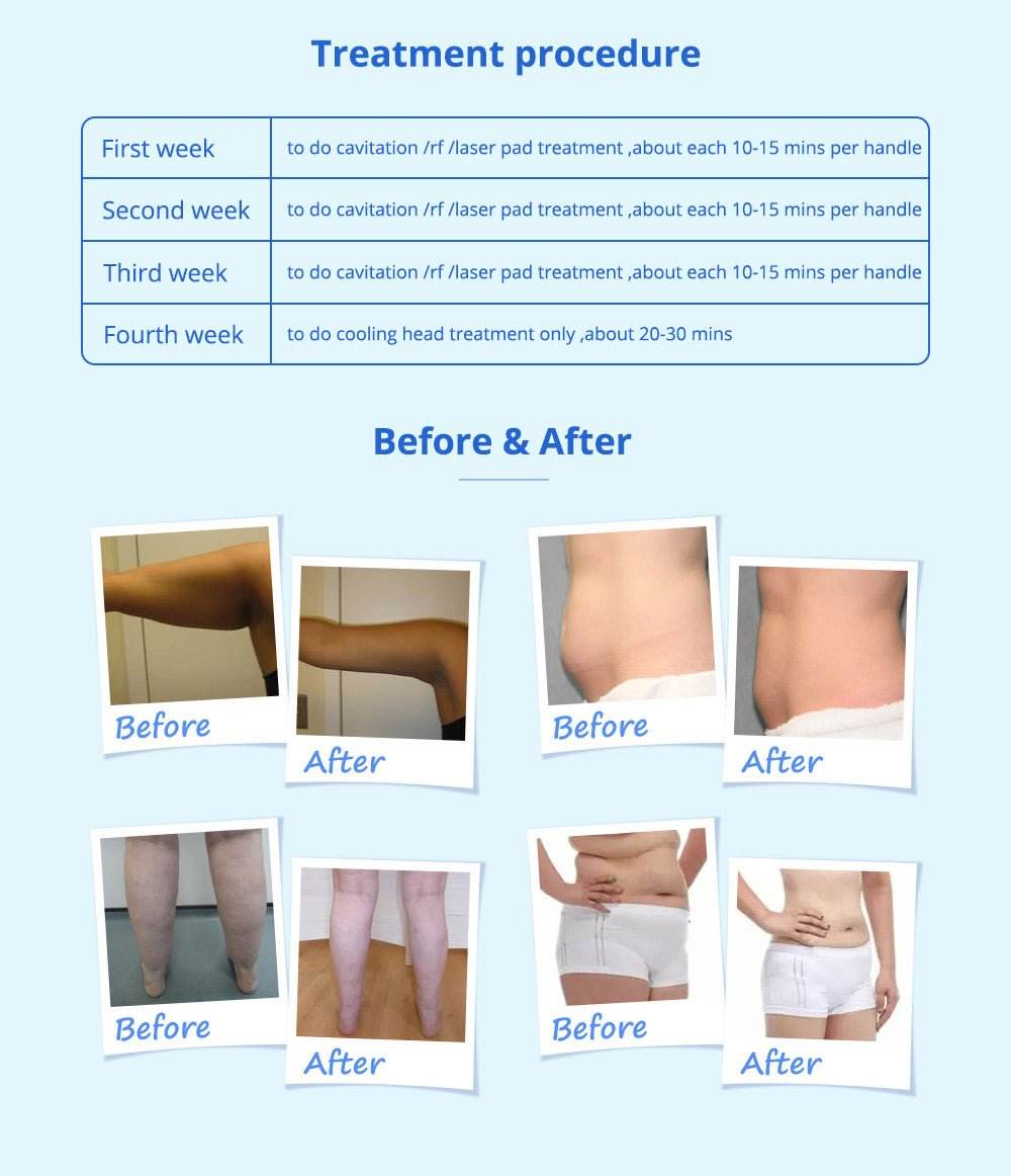 Shape Tactics 5-in-1 Cavitation Cryolipolysis Lipo Laser System - Machine Horizon